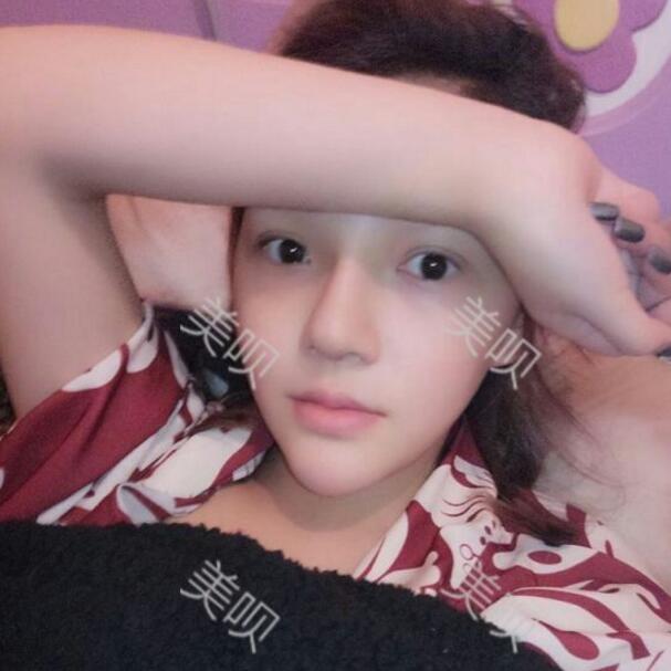 重慶聯(lián)合麗格做的硅膠假體隆鼻自我感覺(jué)很漂亮哦