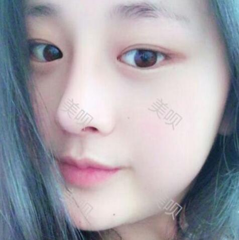 把自己的自體脂肪隆鼻過(guò)程分享給大家我是真的變美了