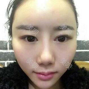 給大家分享下我的自體脂肪面部填充過程希望對大家有幫助