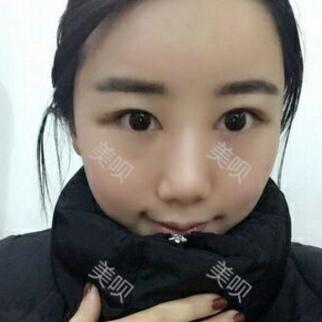 給大家分享下我的自體脂肪面部填充過程希望對大家有幫助