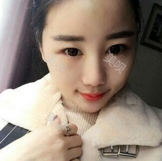 給大家分享下我的自體脂肪面部填充過程希望對大家有幫助