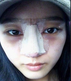 假體隆鼻手術(shù)過程前后對比圖片