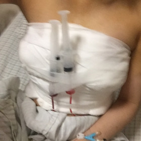 去年10月做的假體隆胸手術(shù)，大家來(lái)看看怎么樣