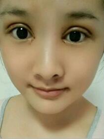 去年12月初在南京韓辰做的雙眼皮，大家來(lái)看看果怎么樣?