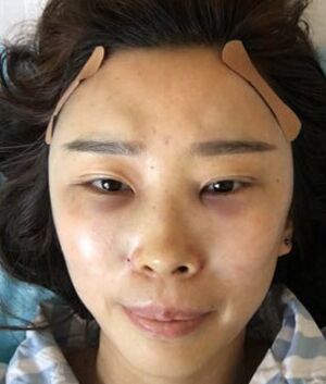 自體脂肪面部填充告別干癟消瘦的臉