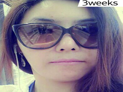 電波l皮除皺讓我彈走小皺紋 果真的很不錯(cuò)