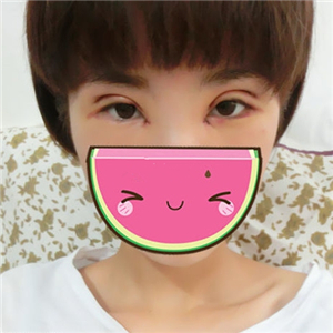 做park法雙眼皮手術(shù)一個(gè)月了，果很好，有恢復(fù)過(guò)程照片哦~~