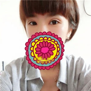 做park法雙眼皮手術(shù)一個(gè)月了，果很好，有恢復(fù)過(guò)程照片哦~~