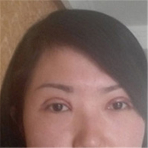 楊亞益醫(yī)生做的雙眼皮+開(kāi)眼角，果不錯(cuò)，看看我的恢復(fù)照片~~~