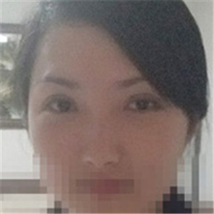 楊亞益醫(yī)生做的雙眼皮+開(kāi)眼角，果不錯(cuò)，看看我的恢復(fù)照片~~~