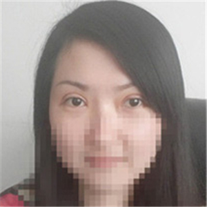 楊亞益醫(yī)生做的雙眼皮+開(kāi)眼角，果不錯(cuò)，看看我的恢復(fù)照片~~~