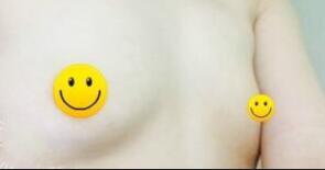 假體隆胸整形前的照片