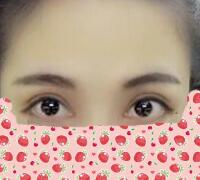 一次性做了全切雙眼皮和開(kāi)內(nèi)眼角兩項(xiàng)整形，佩服自己的勇氣