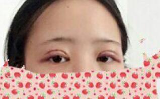全切雙眼皮和開內(nèi)眼角兩項(xiàng)整形,費(fèi)用3880元