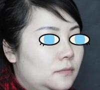 假體隆鼻兩個月了，果挺滿意的