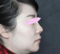 假體隆鼻兩個月了，果挺滿意的