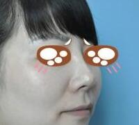 假體隆鼻兩個月了，果挺滿意的