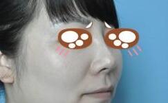 假體隆鼻術(shù)后差不多兩個(gè)月了