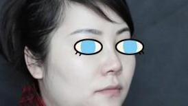 假體隆鼻術(shù)后45°角照片