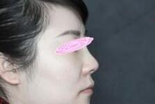 假體隆鼻術(shù)后側(cè)面照片