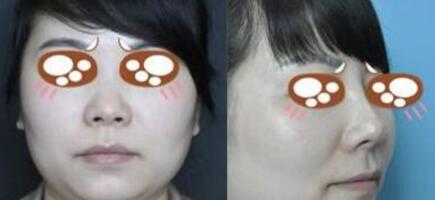 假體隆鼻手術(shù)前后對(duì)比圖