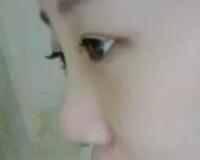 同學(xué)做了隆鼻，我也去做了個假體隆鼻，臉型真心立體了好多
