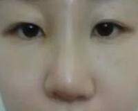 同學(xué)做了隆鼻，我也去做了個假體隆鼻，臉型真心立體了好多