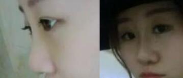 假體隆鼻手術(shù)前后果對比圖