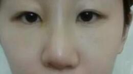 假體隆鼻第三天