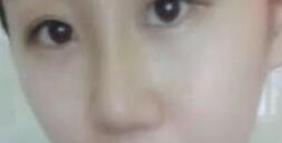 假體隆鼻恢復圖