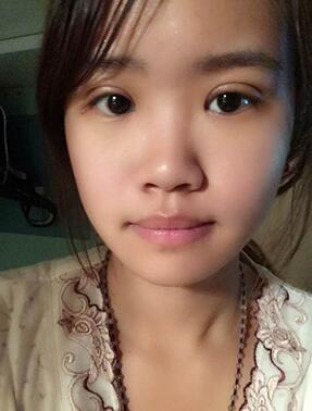 納米x雕雙眼皮15天了~ 我恢復(fù)的算快嗎