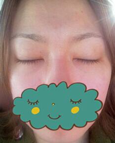 杭州時(shí)光激光去眼袋1個(gè)月了