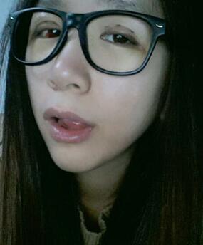 北京常好麗格三點定位雙眼皮恢復一個月經歷