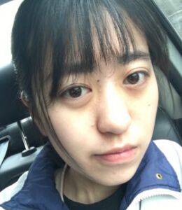 激光點痣不留坑不留疤，果棒棒噠