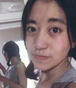 激光點痣不留坑不留疤，果棒棒噠