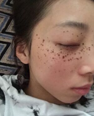 天津維美孫雪做的激光去雀斑后皮膚超干凈