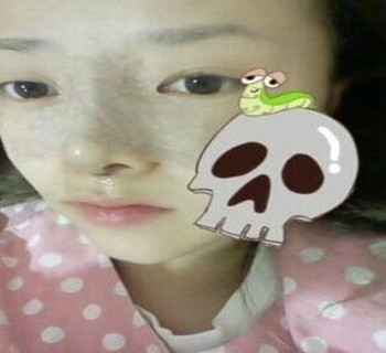 硅膠隆鼻手術(shù)圓了我高鼻梁的夢(mèng)