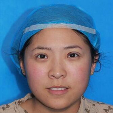 雙眼皮手術(shù)讓我單眼皮變雙眼皮就是這么簡單