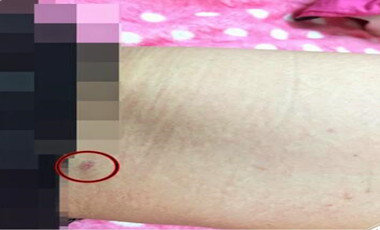 自體脂肪豐胸讓我的小平胸變成大豪乳