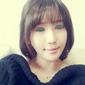 下頜角整形手術(shù)三個(gè)多月了，分享下我的恢復(fù)前后對(duì)比果圖片吧~