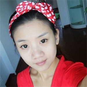 曬曬我做面部吸脂術(shù)前后對(duì)比果照片，中日友好高占巍做的哦~~