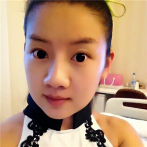 曬曬我做面部吸脂術(shù)前后對(duì)比果照片，中日友好高占巍做的哦~~