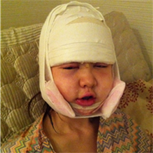 上海華美李志海做的v－line瓜子臉手術，果太好了~哈哈哈~