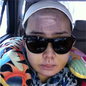 上海華美李志海做的v－line瓜子臉手術，果太好了~哈哈哈~