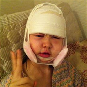 做了v－line瓜子臉手術(shù)八個月了，果很好，看看前后對比照片吧~