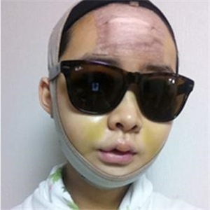 做了v－line瓜子臉手術(shù)八個月了，果很好，看看前后對比照片吧~