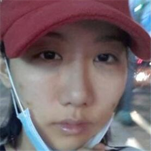 顴骨提高手術(shù)恢復(fù)前后的對比圖片分享，果很好的說~