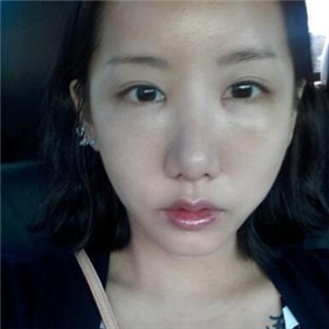 顴骨提高手術(shù)恢復(fù)前后的對比圖片分享，果很好的說~