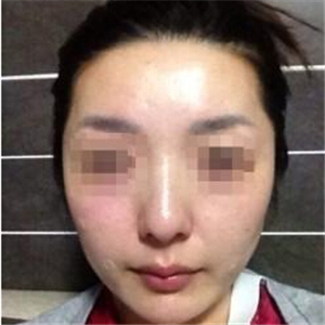 打B****告別大餅?zāi)?，恢?fù)前后的對比果照片給你們看看哦