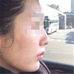 打B****告別大餅?zāi)槪謴?fù)前后的對比果照片給你們看看哦